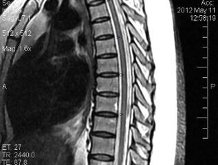 IRM de la colonne thoracique