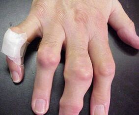 les doigts présentant des déformations articulaires provoquent de la douleur