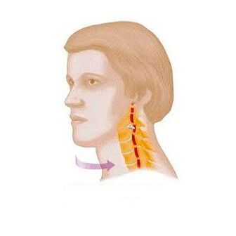 syndrome vertébral avec ostéochondrose cervicale