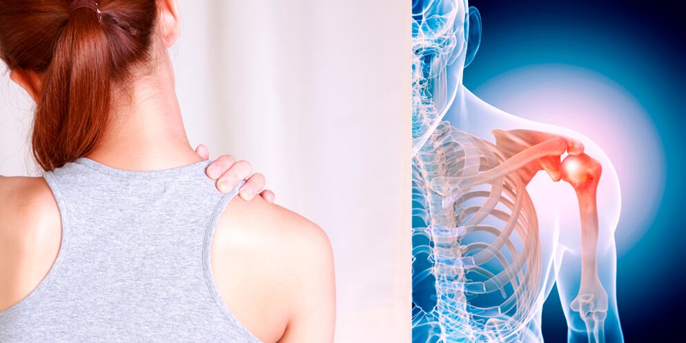 Le développement de l'arthrose de l'épaule entraîne progressivement une douleur constante