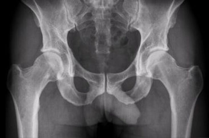 radiographie de l'articulation de la hanche pour la douleur