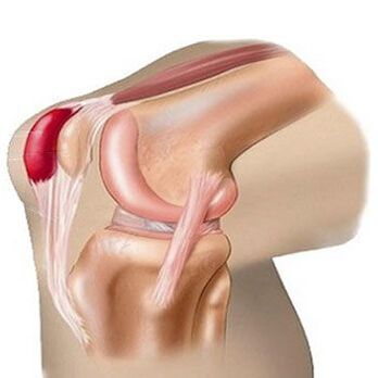 La bursite est l’une des causes de la douleur dans l’articulation du genou. 