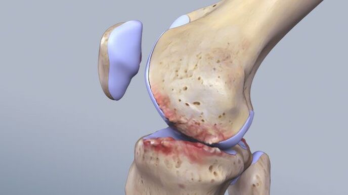 La structure de l'articulation du genou affectée par la pathologie