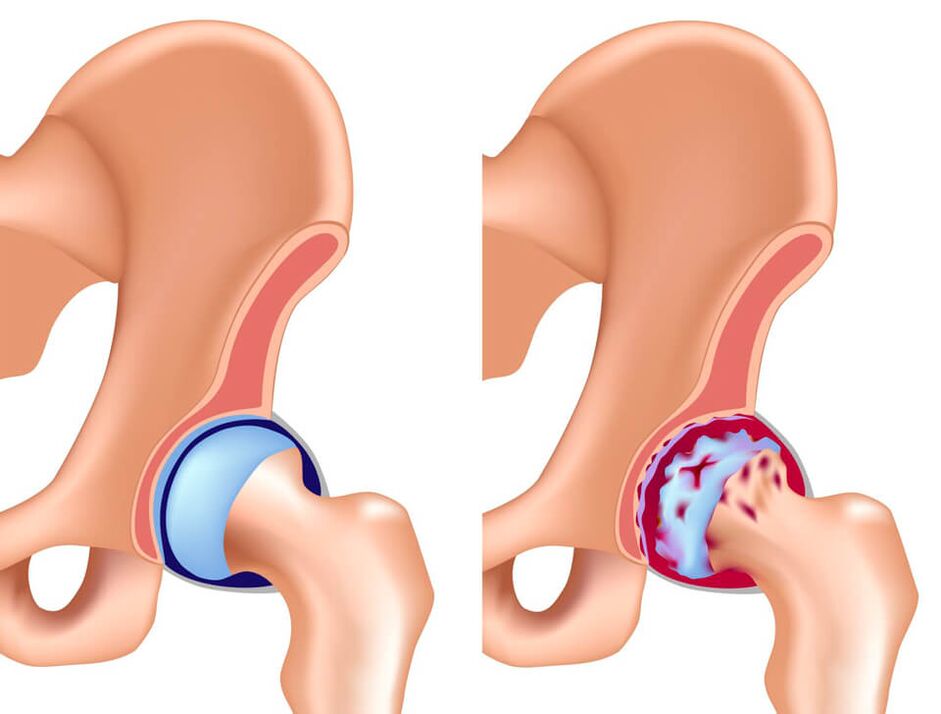 La coxarthrose est la cause la plus fréquente de douleur dans l’articulation de la hanche. 
