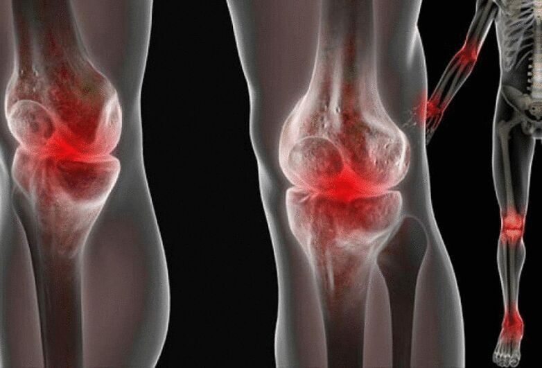 Douleurs dans les articulations des bras et des jambes causées par diverses maladies