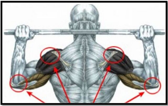 La charge sur les muscles de l'épaule et du coude est l'une des causes de l'arthrose de l'articulation de l'épaule. 
