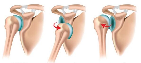 Luxation antérieure et postérieure de l'articulation de l'épaule, provoquant le développement de l'arthrose