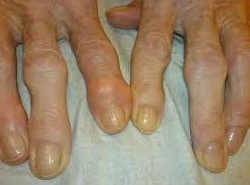 L'arthrose des petites articulations des mains