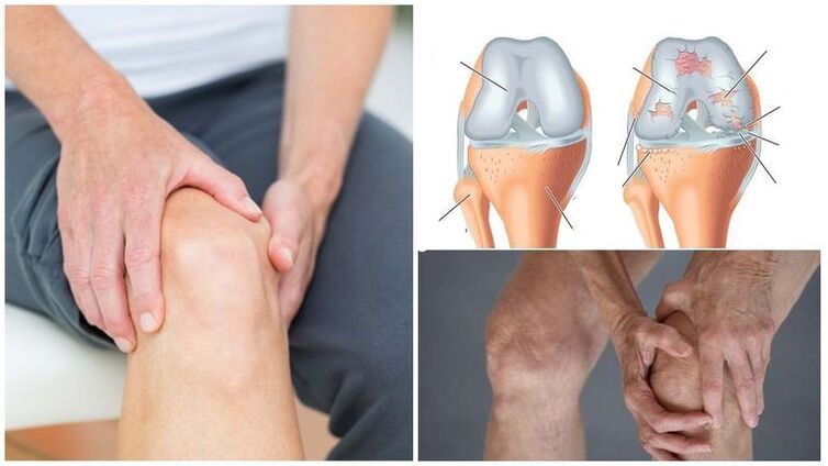 Symptôme de douleur au genou de l'arthrose de l'articulation du genou