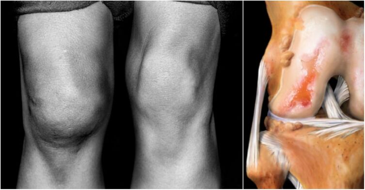arthrose de l'articulation du genou et de l'articulation endolori