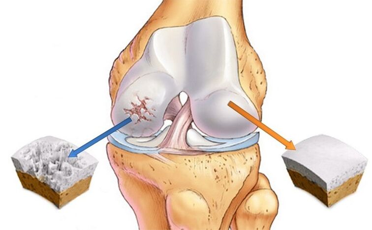 cartilage normal et affecté par l'arthrose