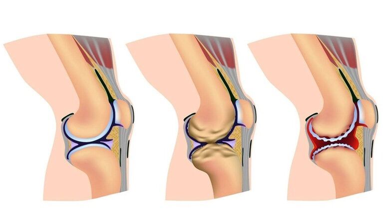 Étapes de déformation dans l'articulation du genou pour l'arthrose