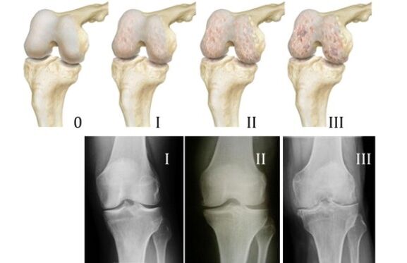 méthodes de diagnostic de l'arthrose du genou