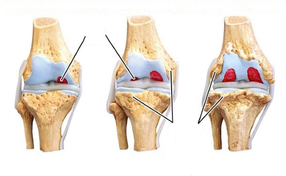 stades de l'arthrose du genou